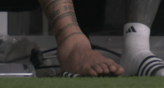 메시 발목 근황